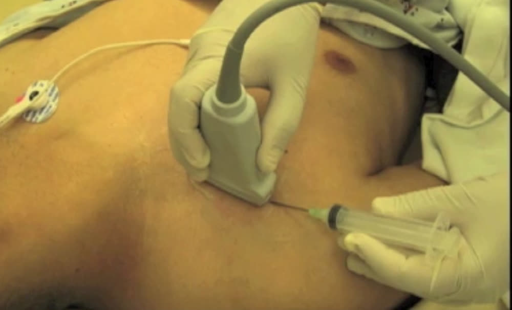Medial approach - infraclavicular puncture through the pectoralis muscles