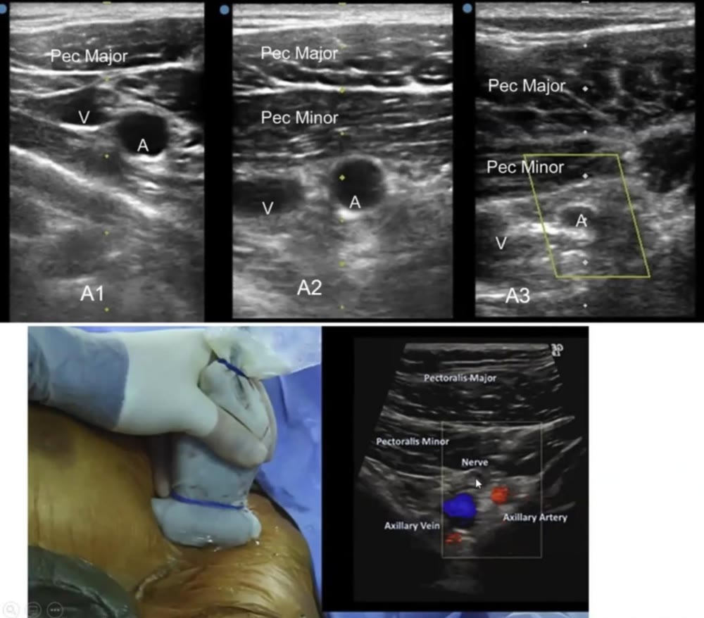 Ultrasound appearance of the first, second and third axillary artery segments