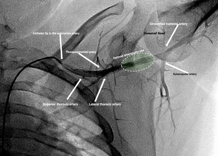 Axillary artery angiogram performed from a femoral catheter